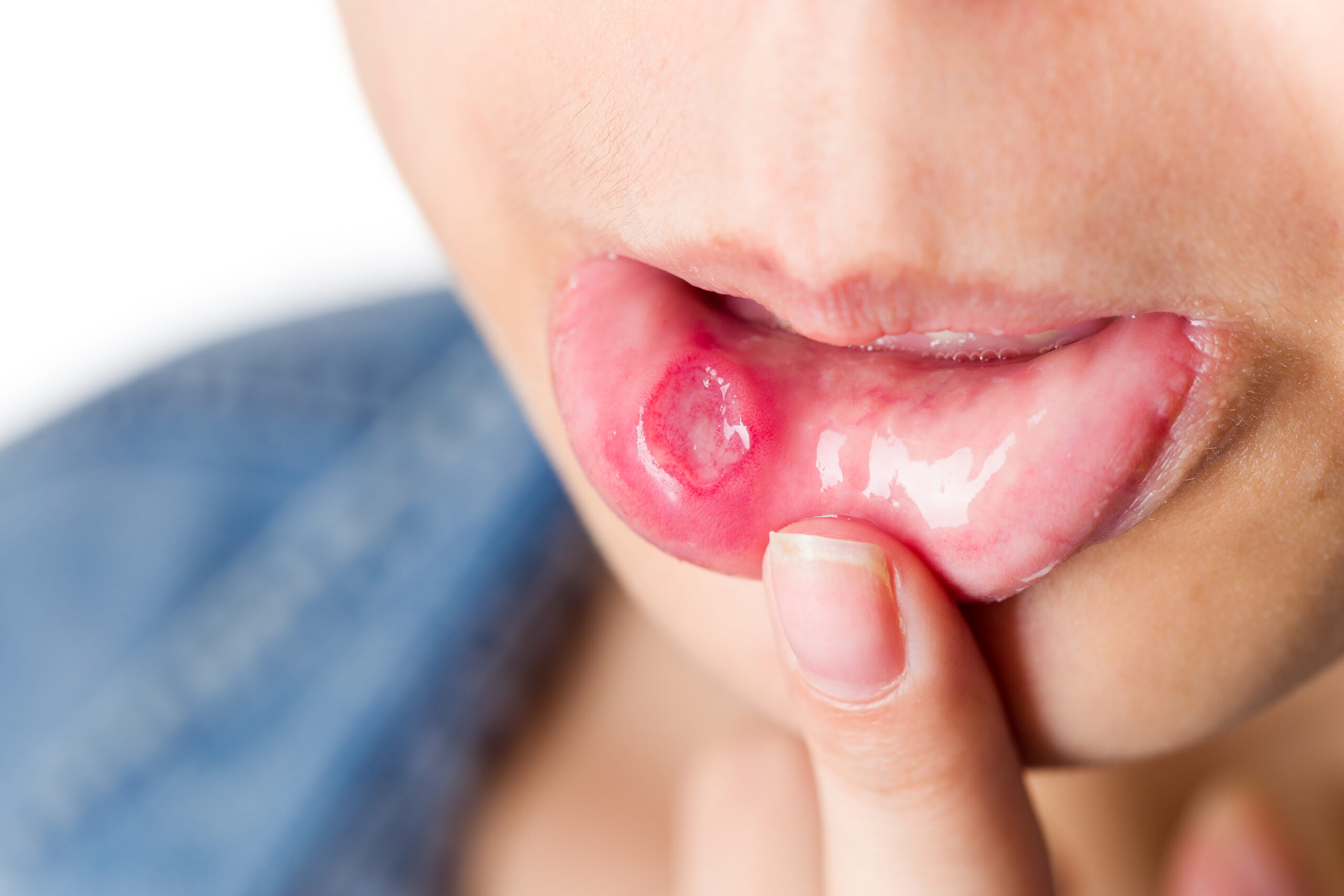 Oral herpes symptom pictures